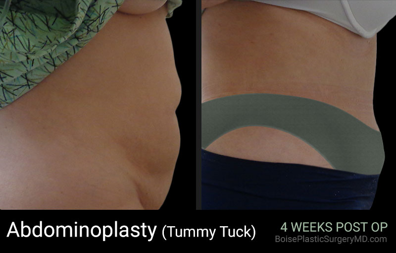 Abdominoplasty-Patient F (Side)