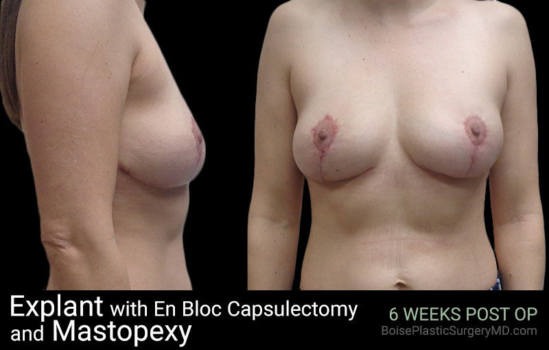 Explant with En Bloc Capsulectomy & Mastopexy – M