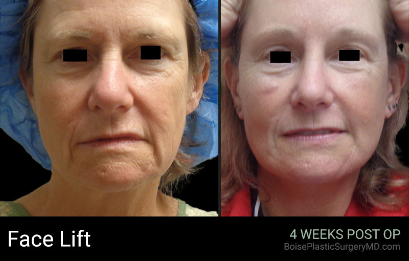 Face Lift – Patient A