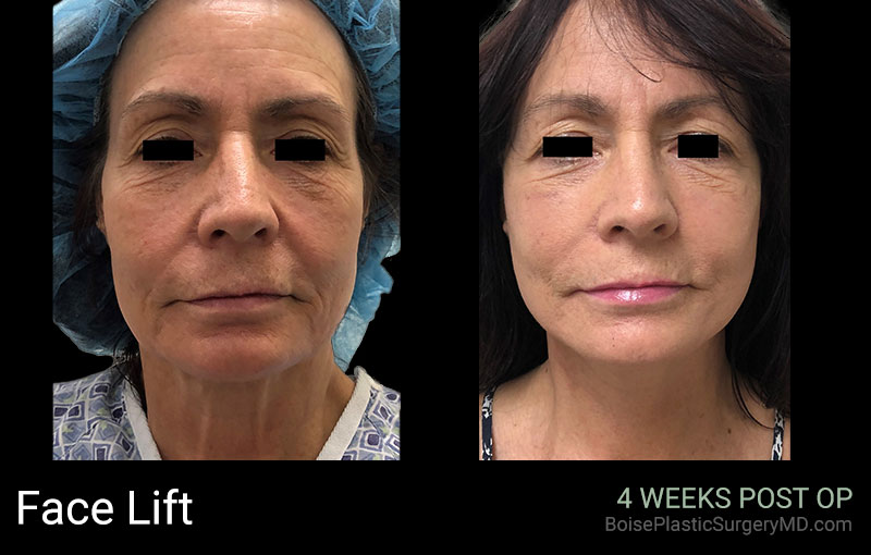 Face Lift (Patient C) - Boise Plastic Surgery
