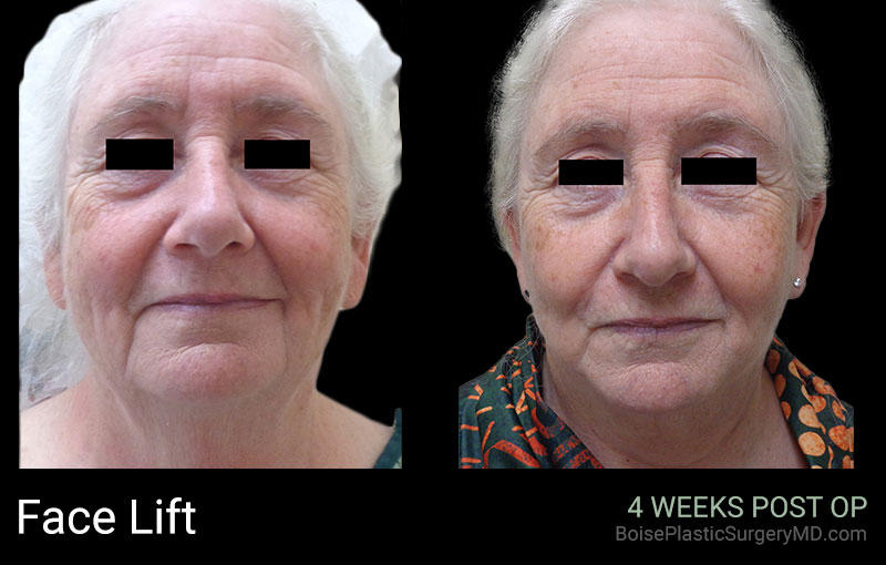 Face Lift - Patient D