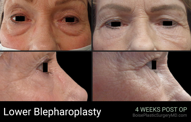 Lower Blepharoplasty – Patient B
