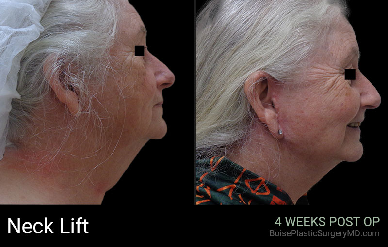 Neck Lift (Patient C) - Boise Plastic Surgery