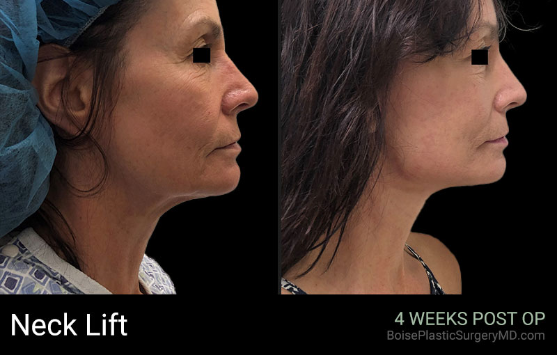 Neck Lift (Patient D) - Boise Plastic Surgery