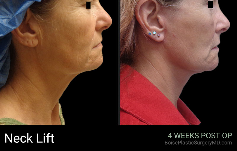 Neck Lift – Patient A