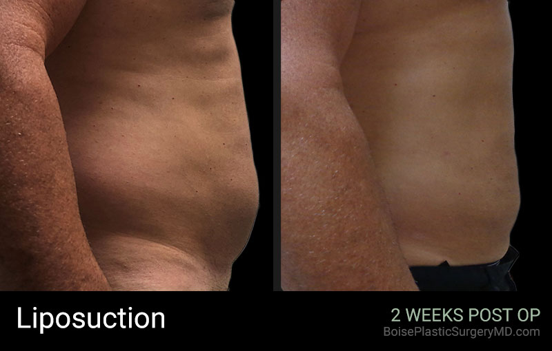 Liposuction – Patient A (Side)