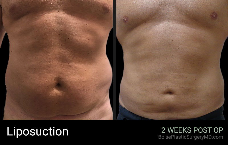 Body-Liposuction-A