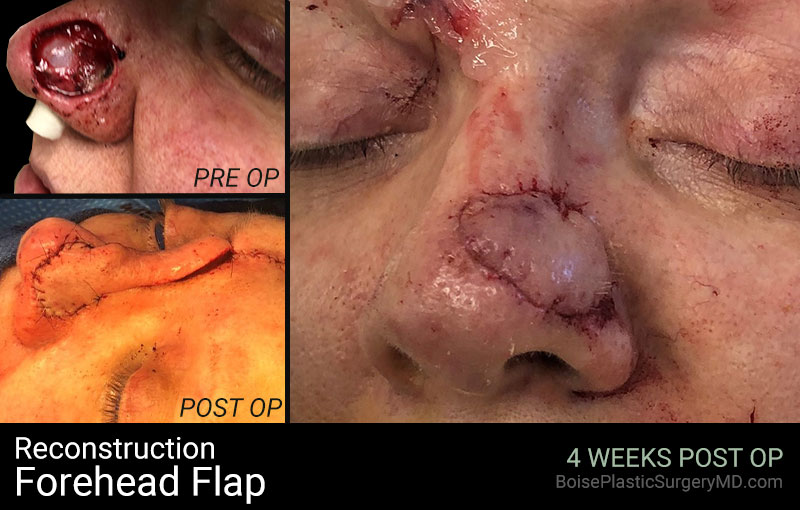 Reconstruction-Forehead Flap (Patient A)