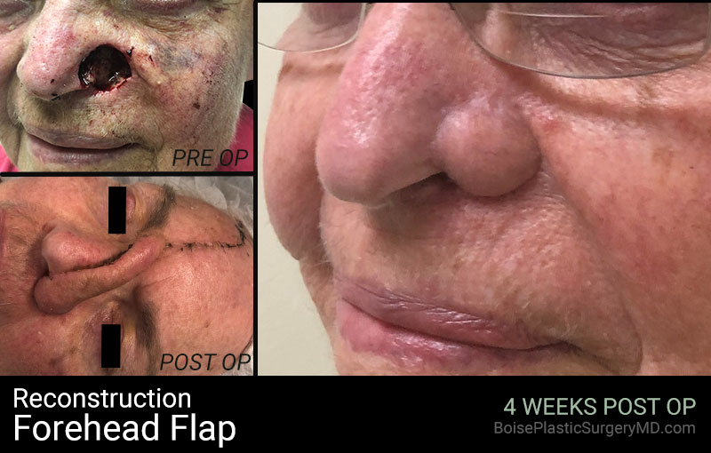 Reconstruction-Forehead Flap (Patient B)