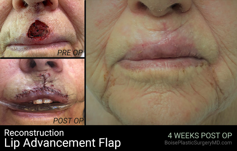 Lip Advancement Flap - Patient A