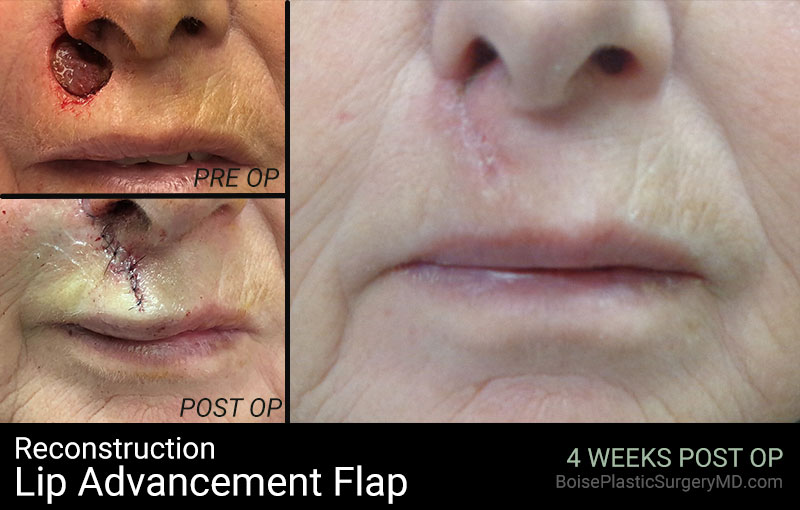 Reconstruction-Lip Advancement Flap (Patient B)