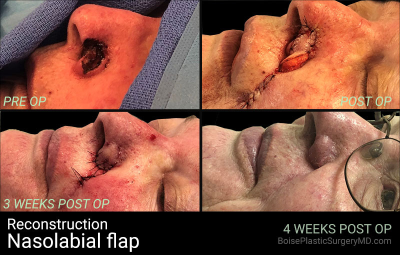 Nasolabial Flap - Patient A
