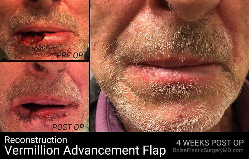 Reconstruction-Vermillion Advancement Flap