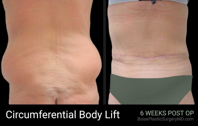 Circumferential Body Lift - Patient A - Back