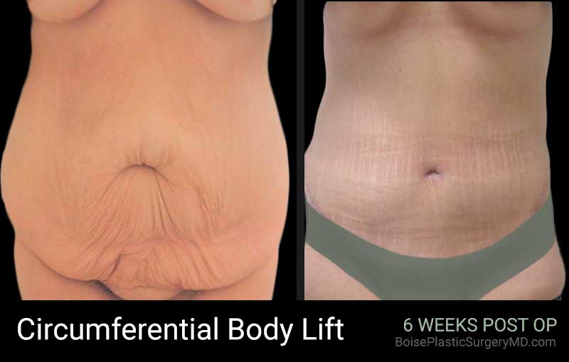 Circumferential Body Lift - Patient B - Front