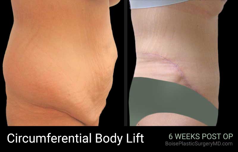 Circumferential Body Lift – Patient B – Side