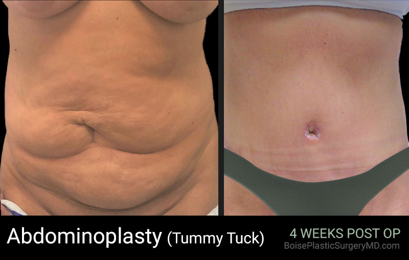 Abdominoplasty-Patient G (Front)