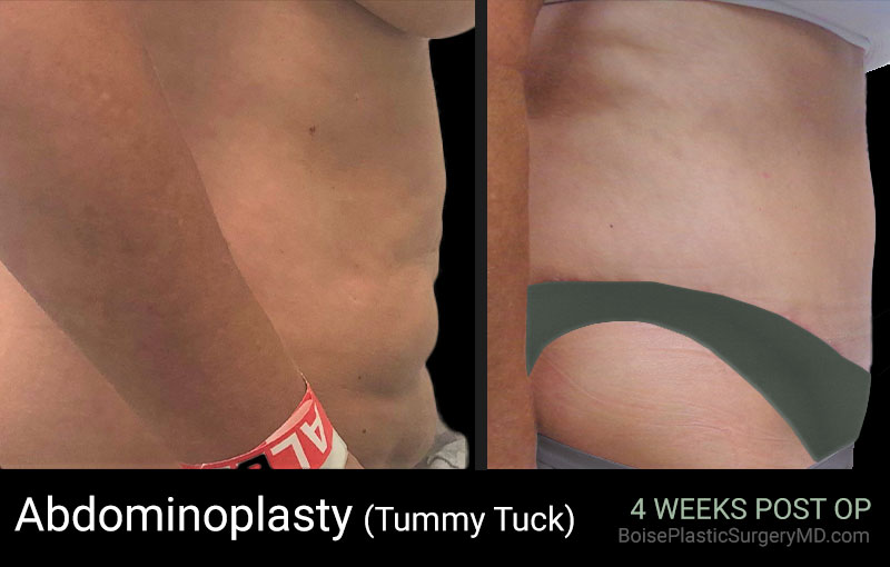 Abdominoplasty-Patient G (Side)