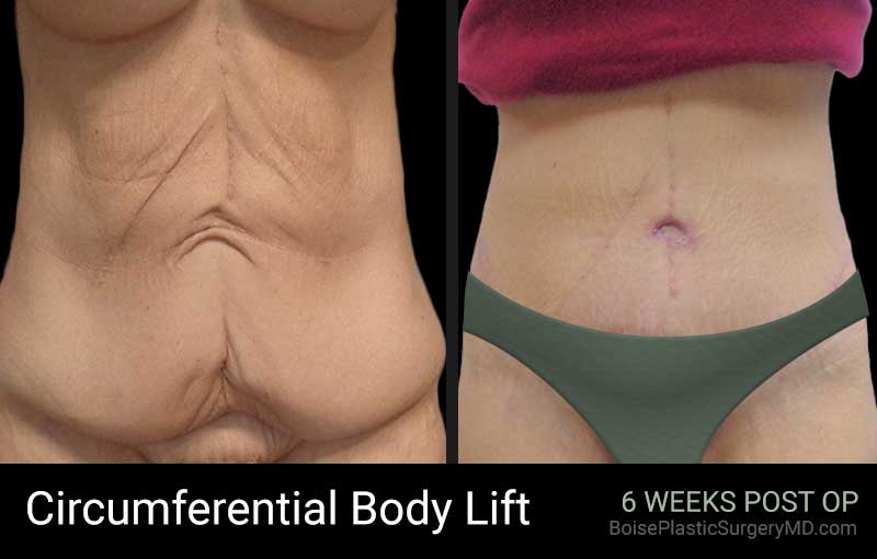 Circumferential Body Lift