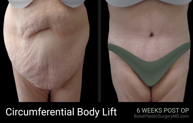 Circumferential Body Lift