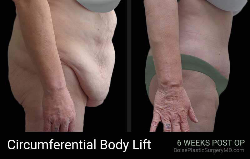 Circumferential Body Lift – Patient D – Side