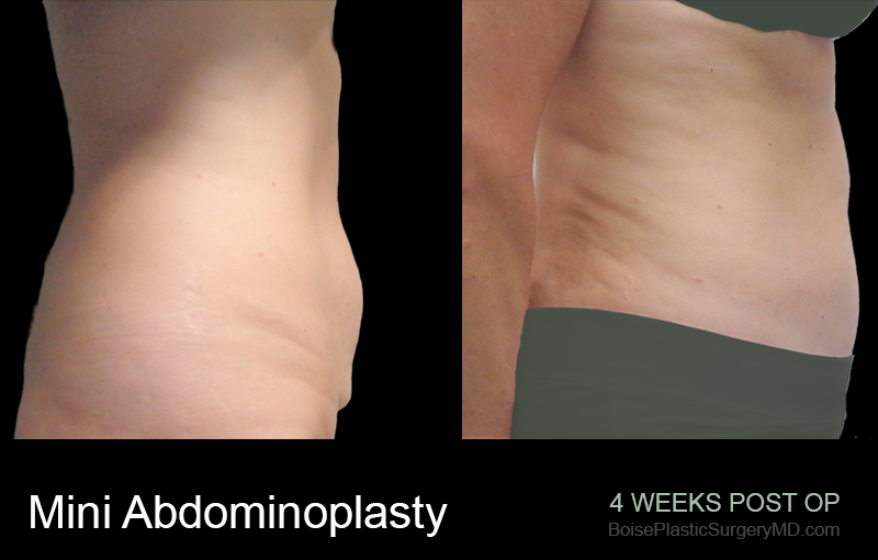 Mini Abdominoplasty – Patient B