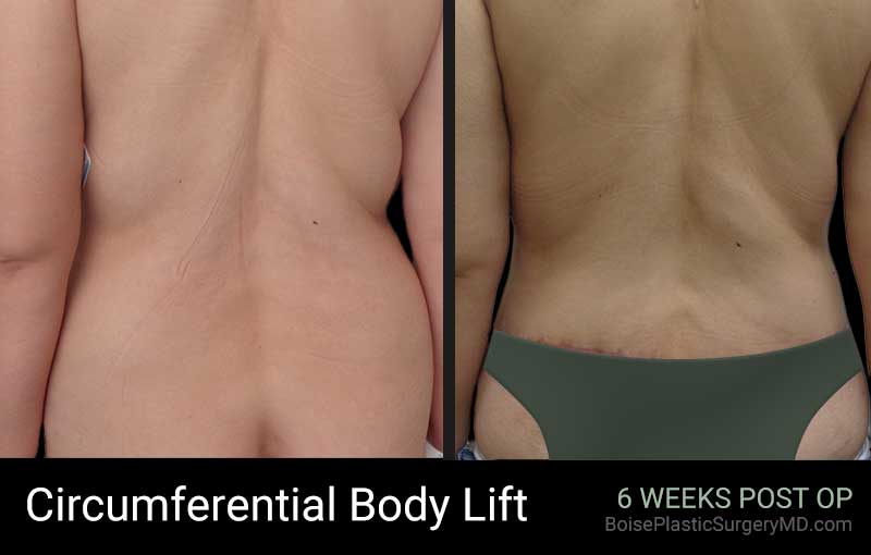 Circumferential Body Lift – Patient E – Back