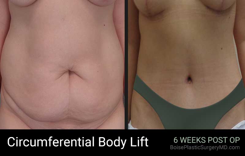 Circumferential Body Lift – Patient E – Front