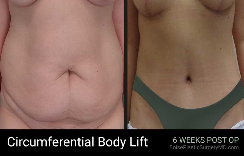 Circumferential Body Lift