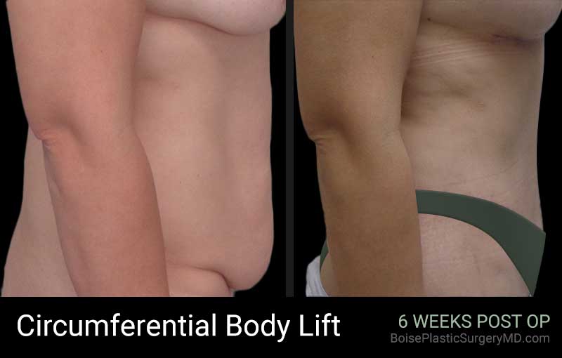 Circumferential Body Lift – Patient E – Side