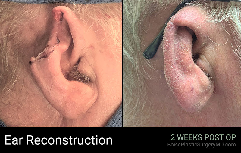 Ear reconstruction before and after