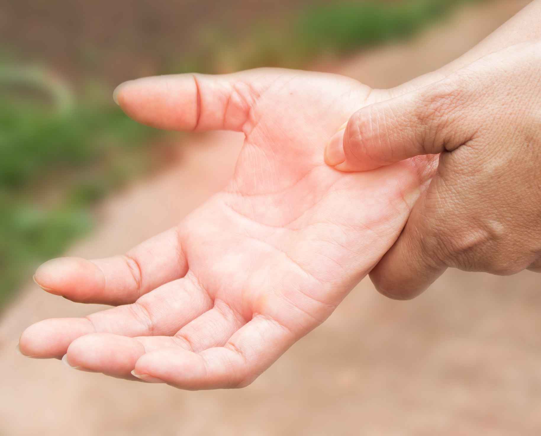 Hand with Carpal Tunnel Syndrome - Boise Plastic Surgery and Hand Center