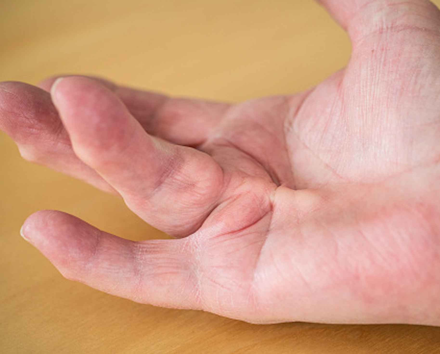 Dupuytrens Carpal Tunnel Syndrome - Boise Plastic Surgery and Hand Center