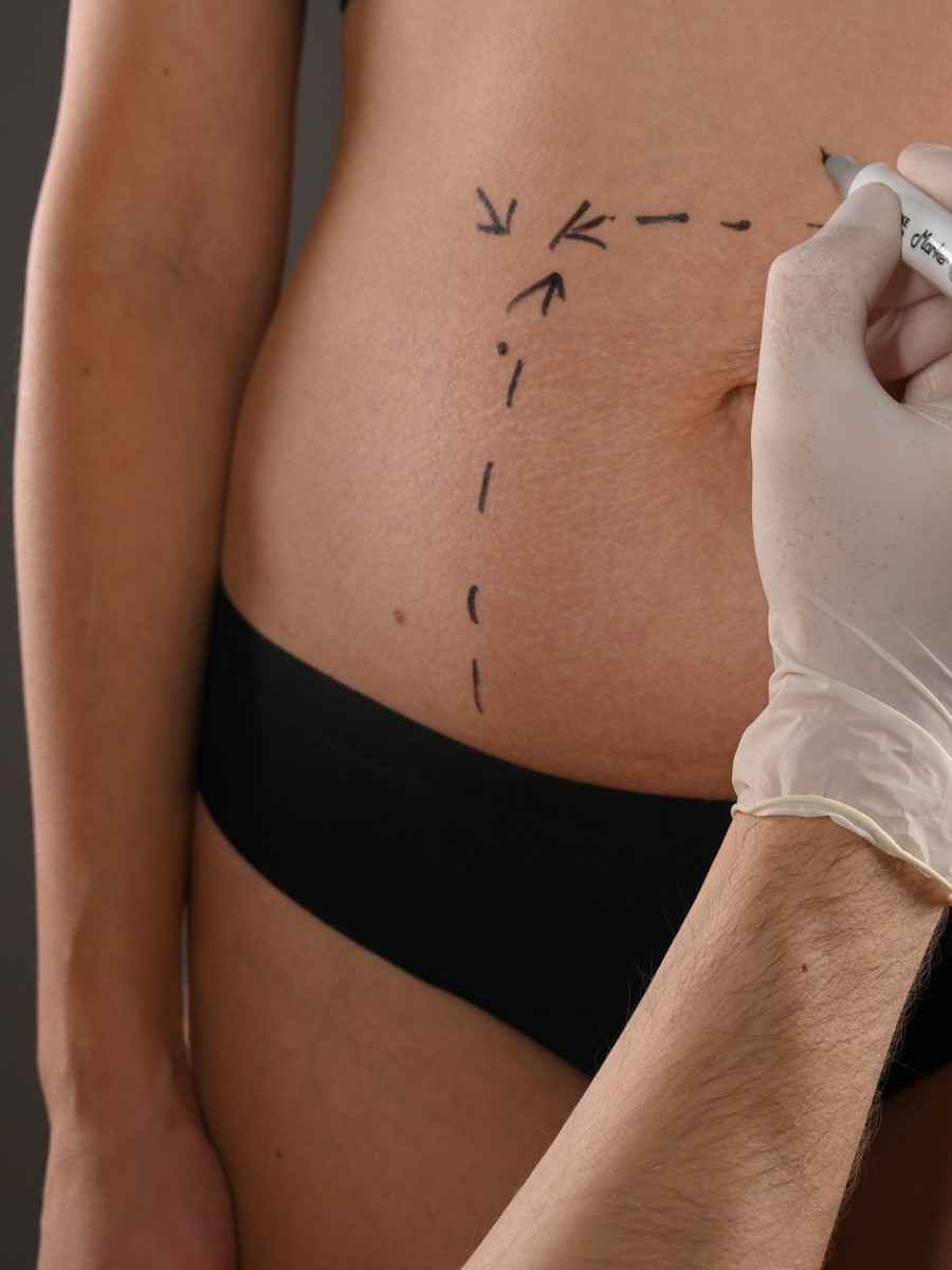 Tummy tuck surgery - Boise Plastic Surgery and Hand Center