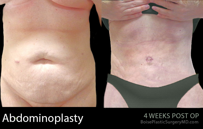 Abdominoplasty-1