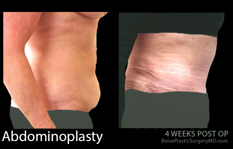 Abdominoplasty-7-2