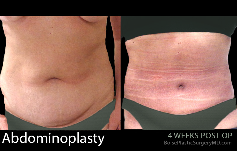 Abdominoplasty-7