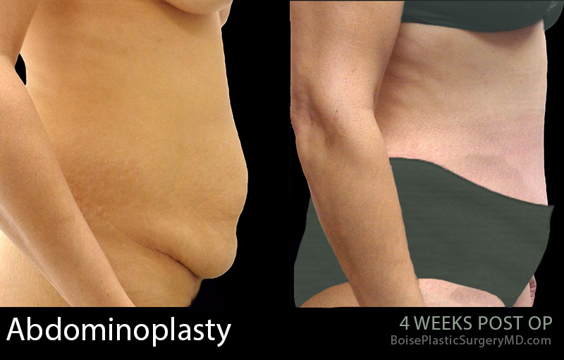 Abdominoplasty-2-2