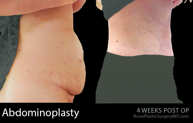 Abdominoplasty-2