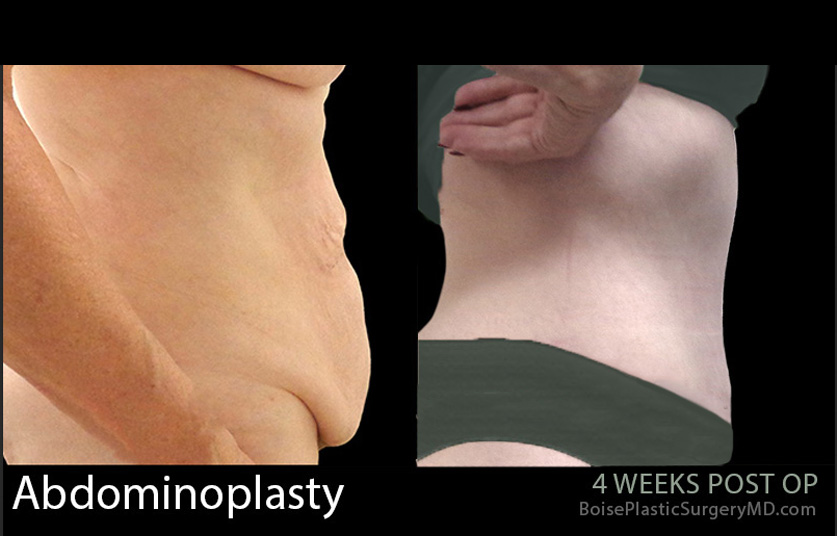 Abdominoplasty-3-2