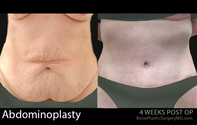 Abdominoplasty-3