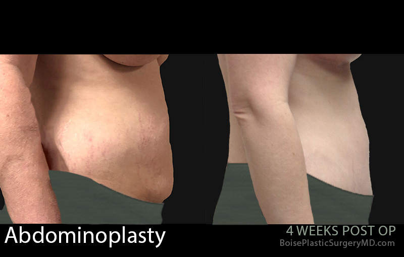 Abdominoplasty-4-2