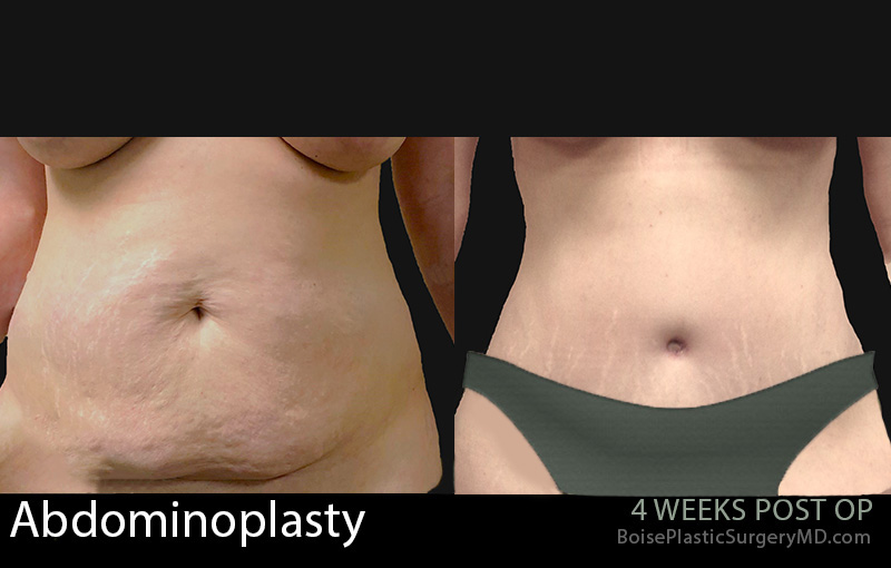 Abdominoplasty-4