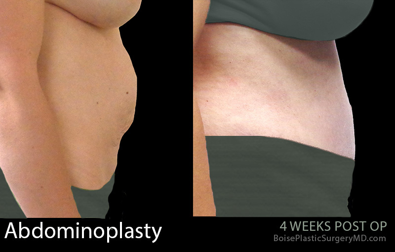 Abdominoplasty-5-2