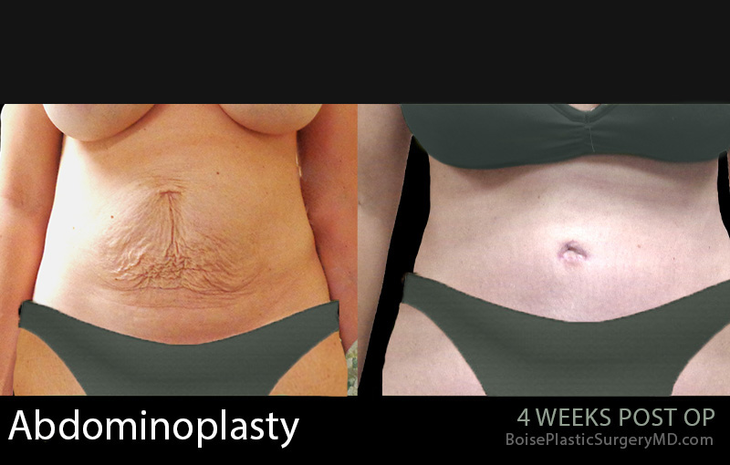 Abdominoplasty-5