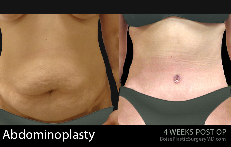 Abdominoplasty-6