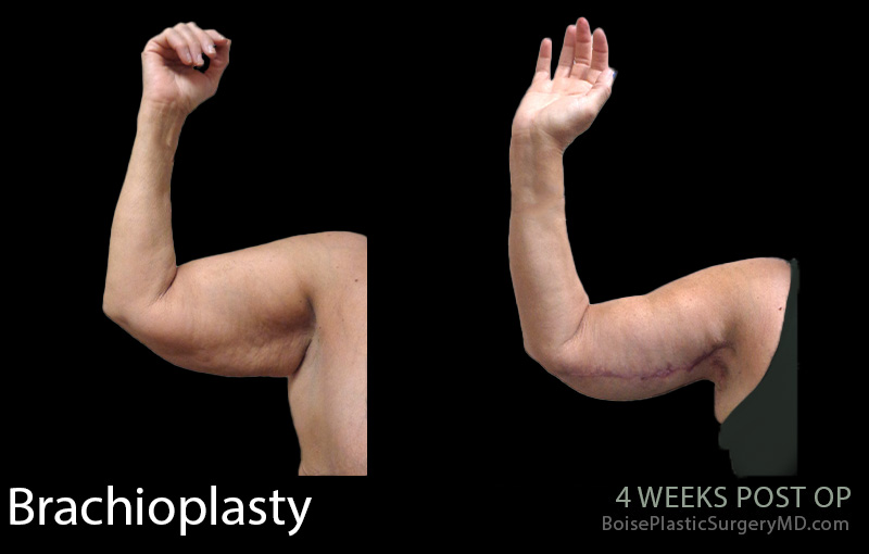 Brachioplasty-2