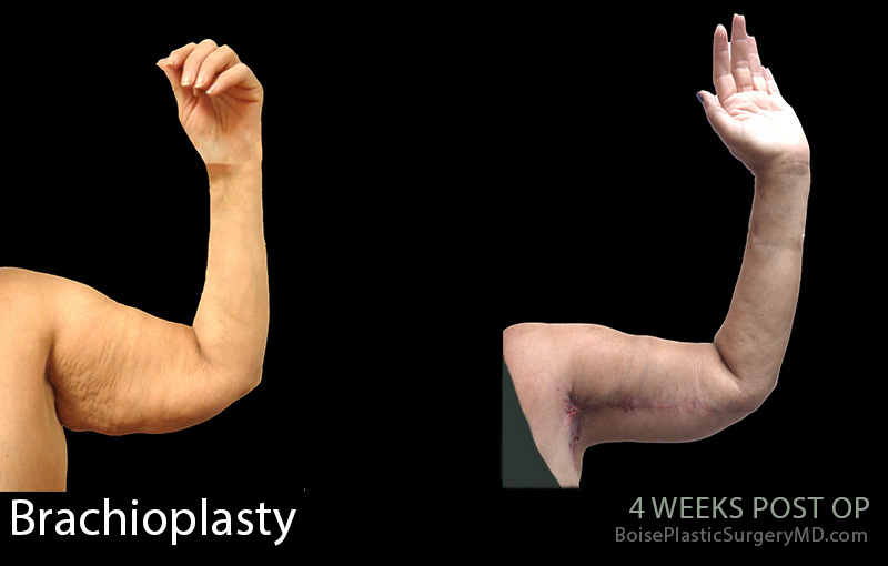 Brachioplasty-1