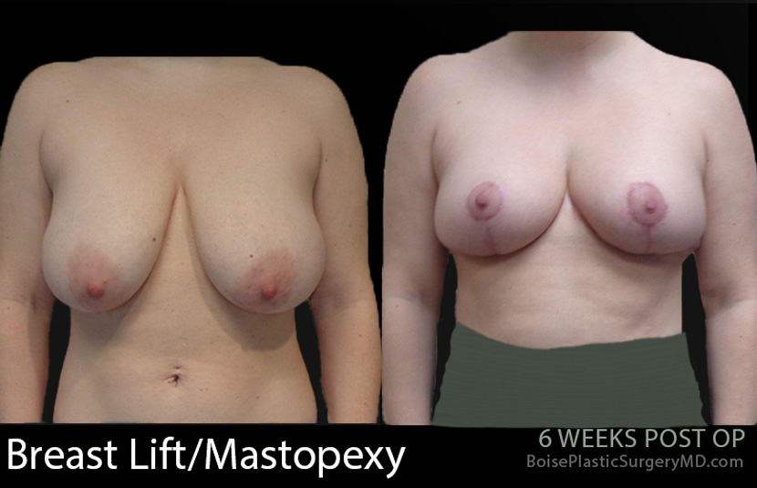 Breast-Lift-Mastopexy-1