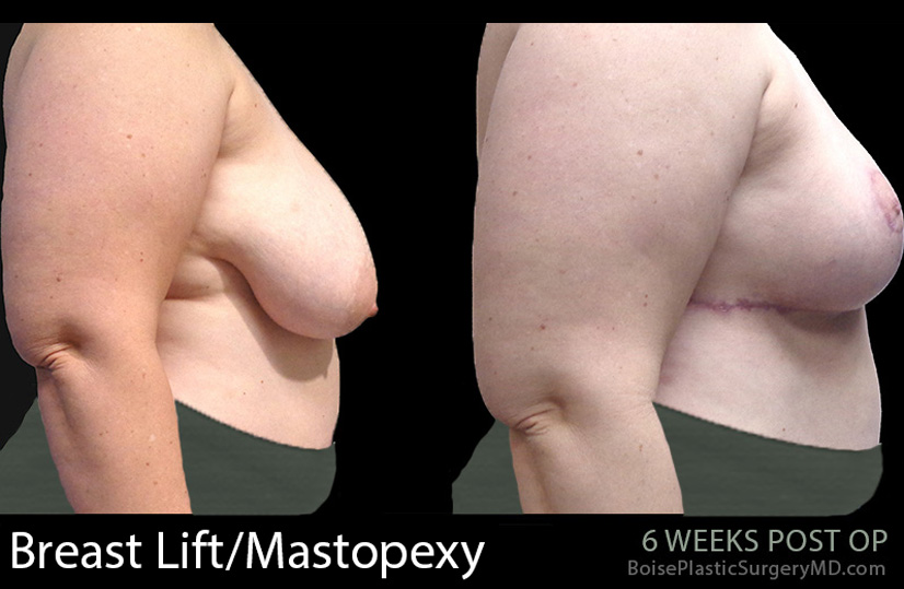 Breast-Lift-Mastopexy-2